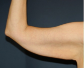 Feel Beautiful - Arm Reduction 208 - Before Photo